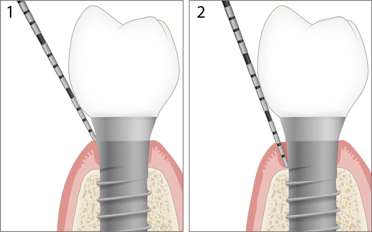 Periimplantäre Rezession sondieren