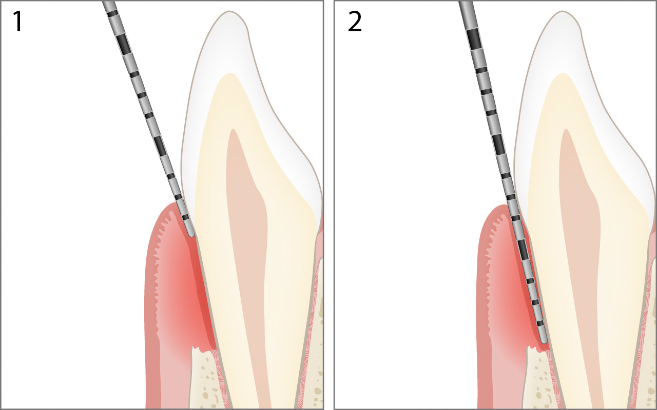 Parodontale Tasche sondieren